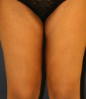 Feel Beautiful - Thigh Lift 200 - After Photo